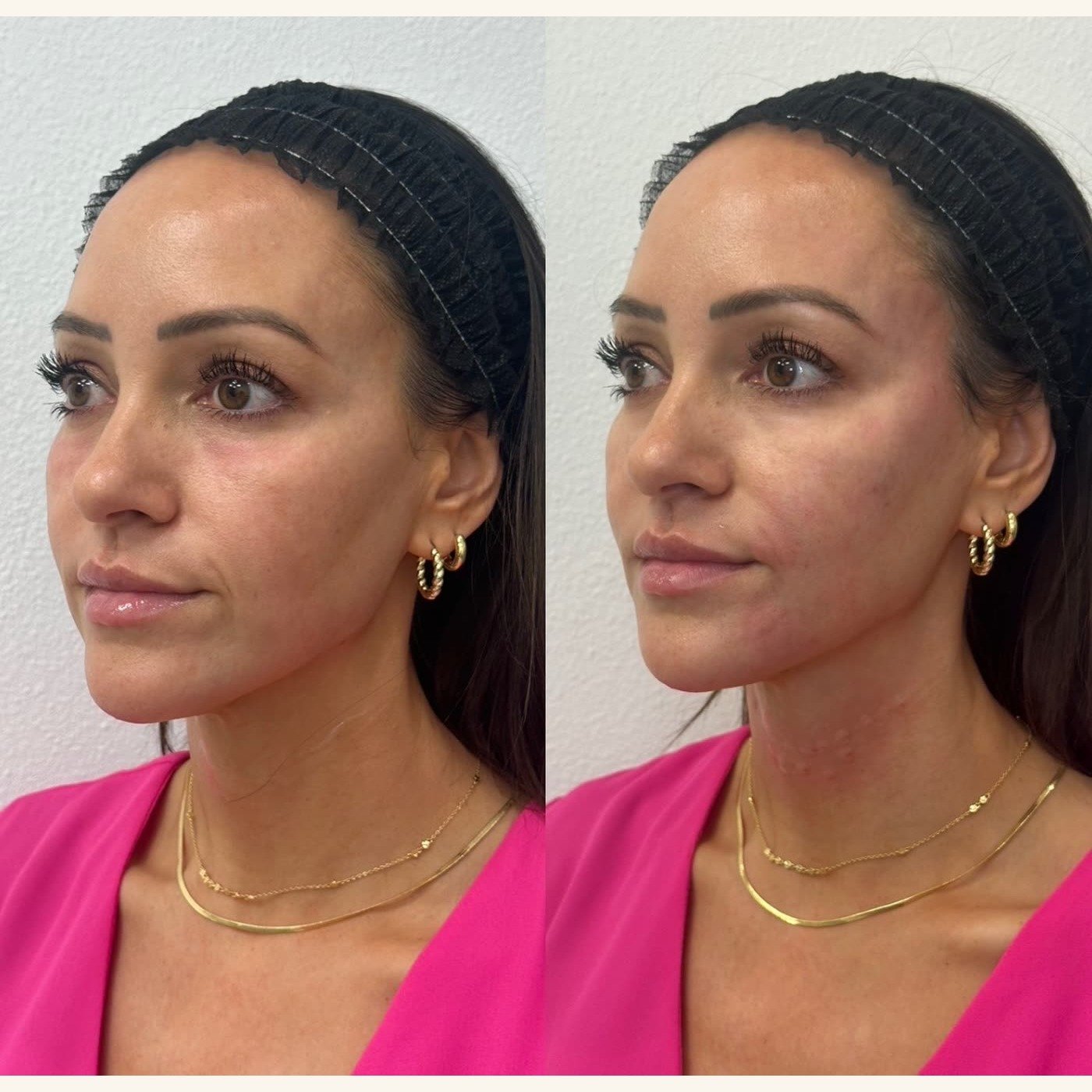 Before and after — cheek and skin refinement at Privé Aesthetics, Dallas