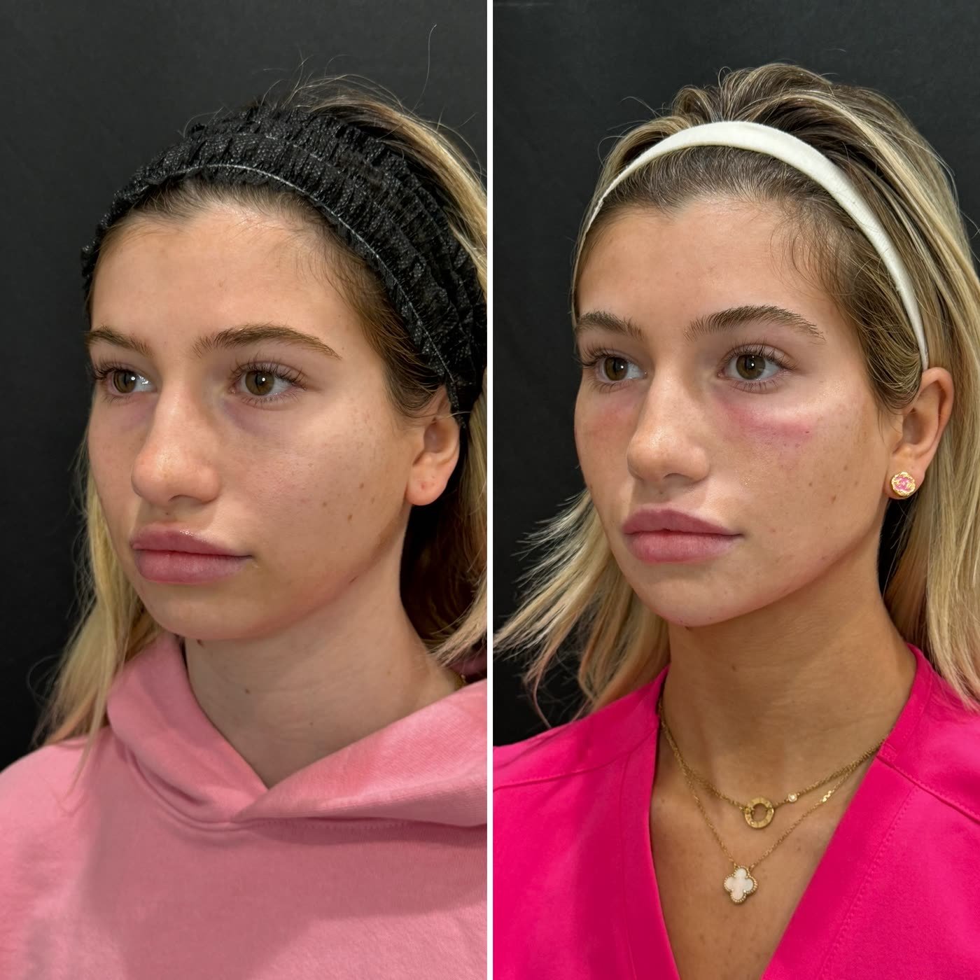 Before and after — subtle balance with filler and Botox at Privé Aesthetics, Dallas