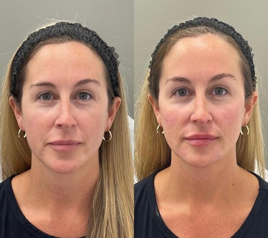 Before and after — facial balancing with injectables at Privé Aesthetics Dallas