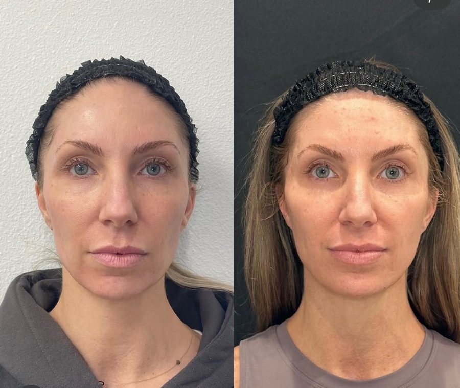 Before and after — Sculptra collagen restoration at Privé Aesthetics Dallas