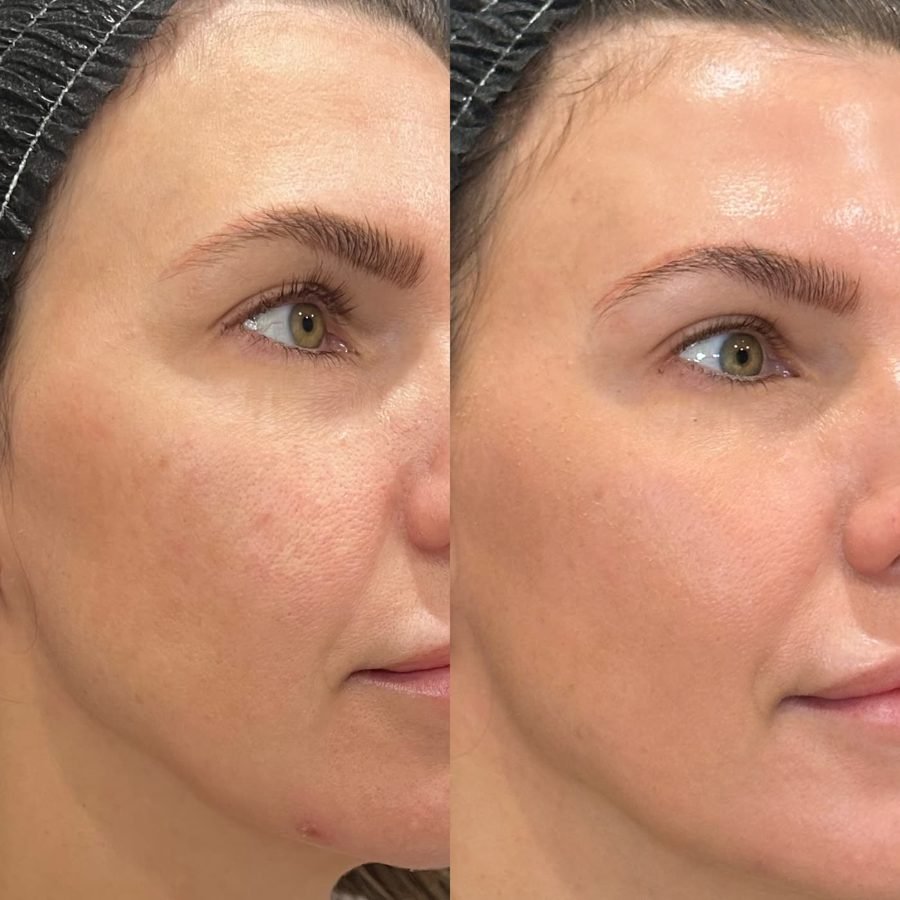 Before and after — skin clarity from laser at Privé Aesthetics Dallas
