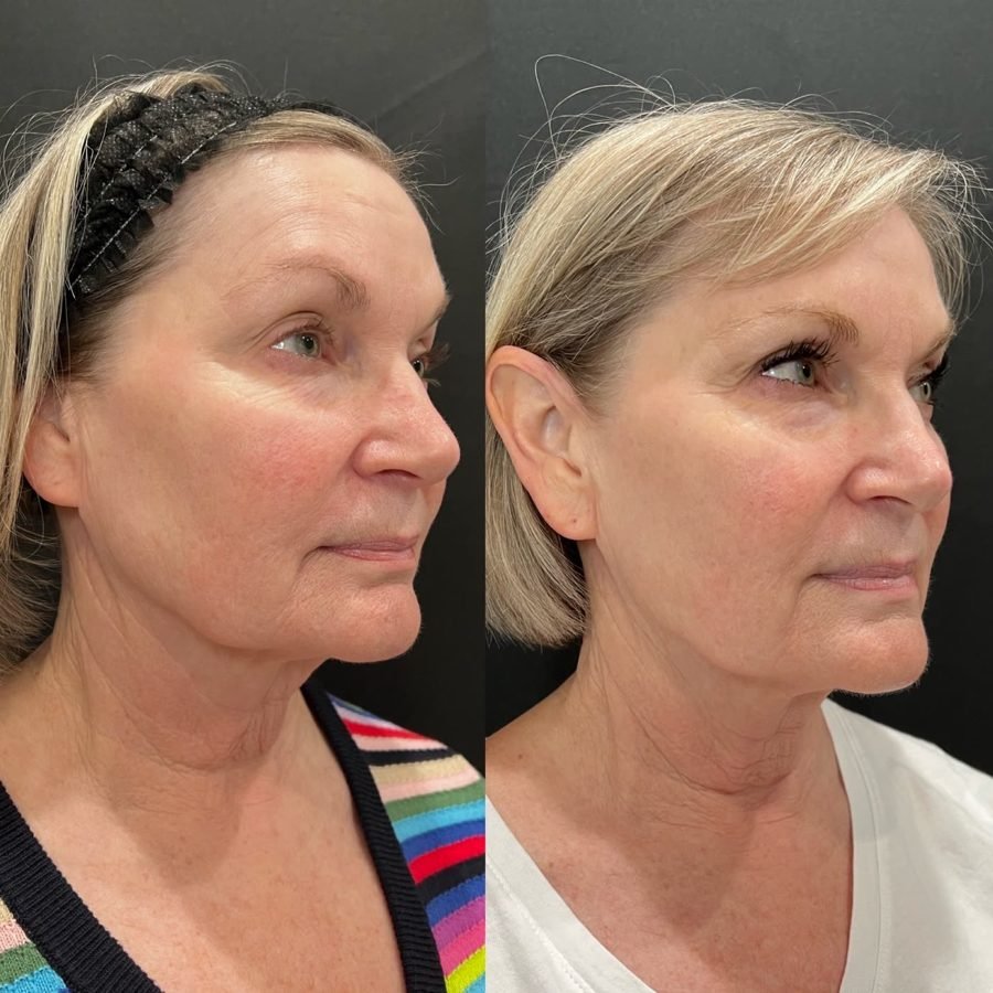 Before and after — non-surgical skin lift at Privé Aesthetics Dallas