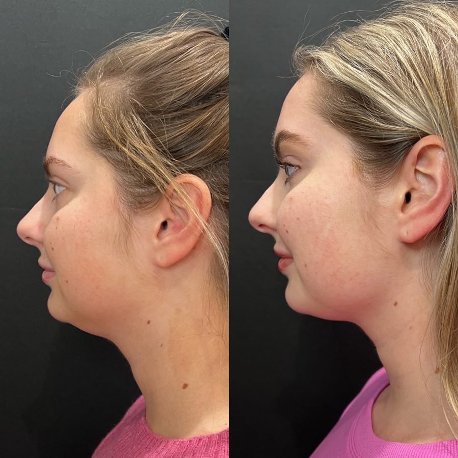 Before and after — truSculpt skin tightening at Privé Aesthetics Dallas