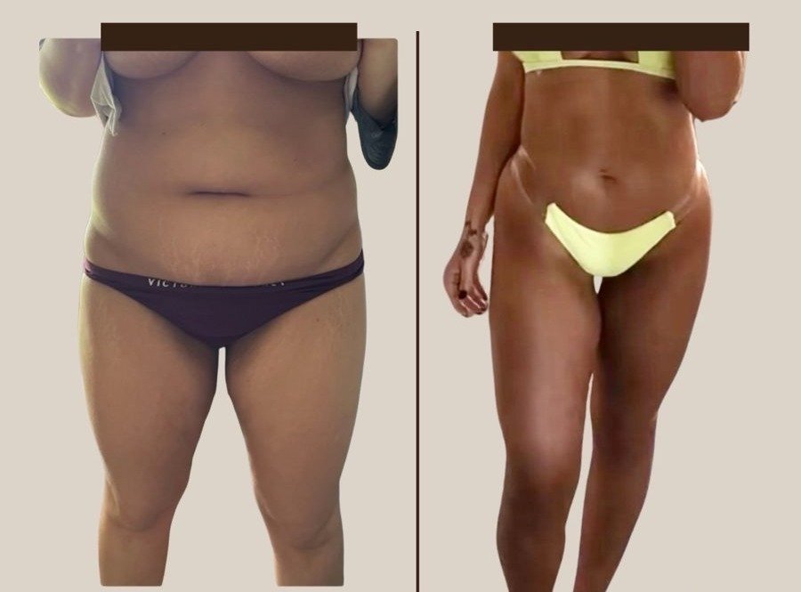Before and after — weight loss and peptide therapy at Privé Aesthetics Dallas