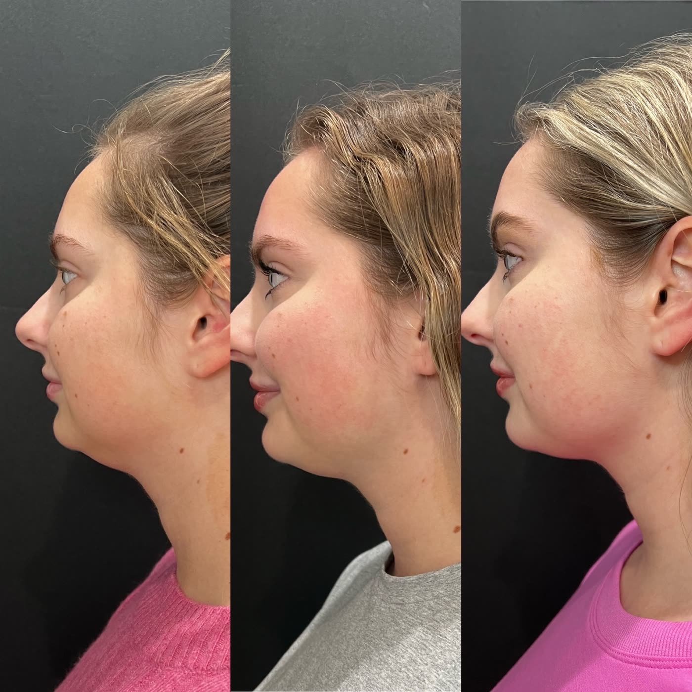 Before and after — three-stage jawline progression at Privé Aesthetics, Dallas