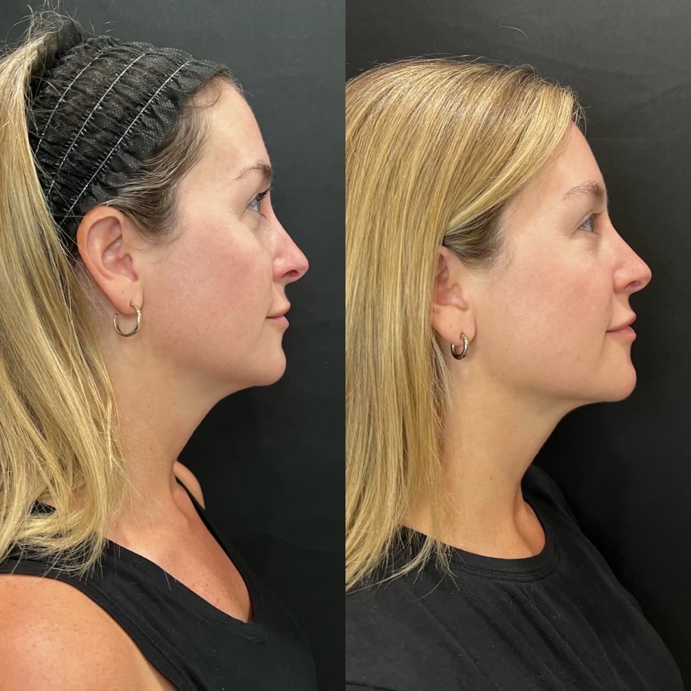 Before and after — jawline definition with Kybella and filler at Privé Aesthetics, Dallas