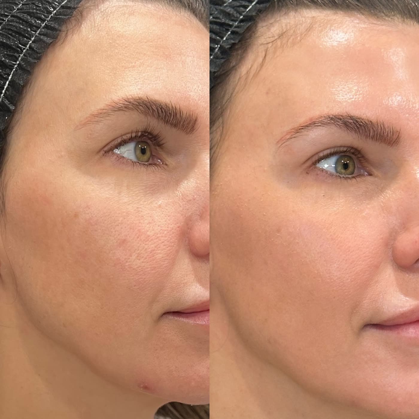 Before and after — skin clarity from a laser series at Privé Aesthetics, Dallas