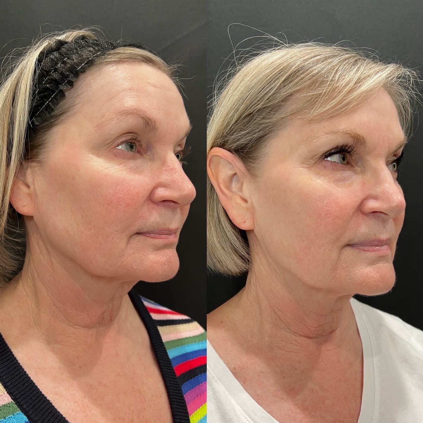 Before and after — non-surgical skin lift and tightening at Privé Aesthetics, Dallas