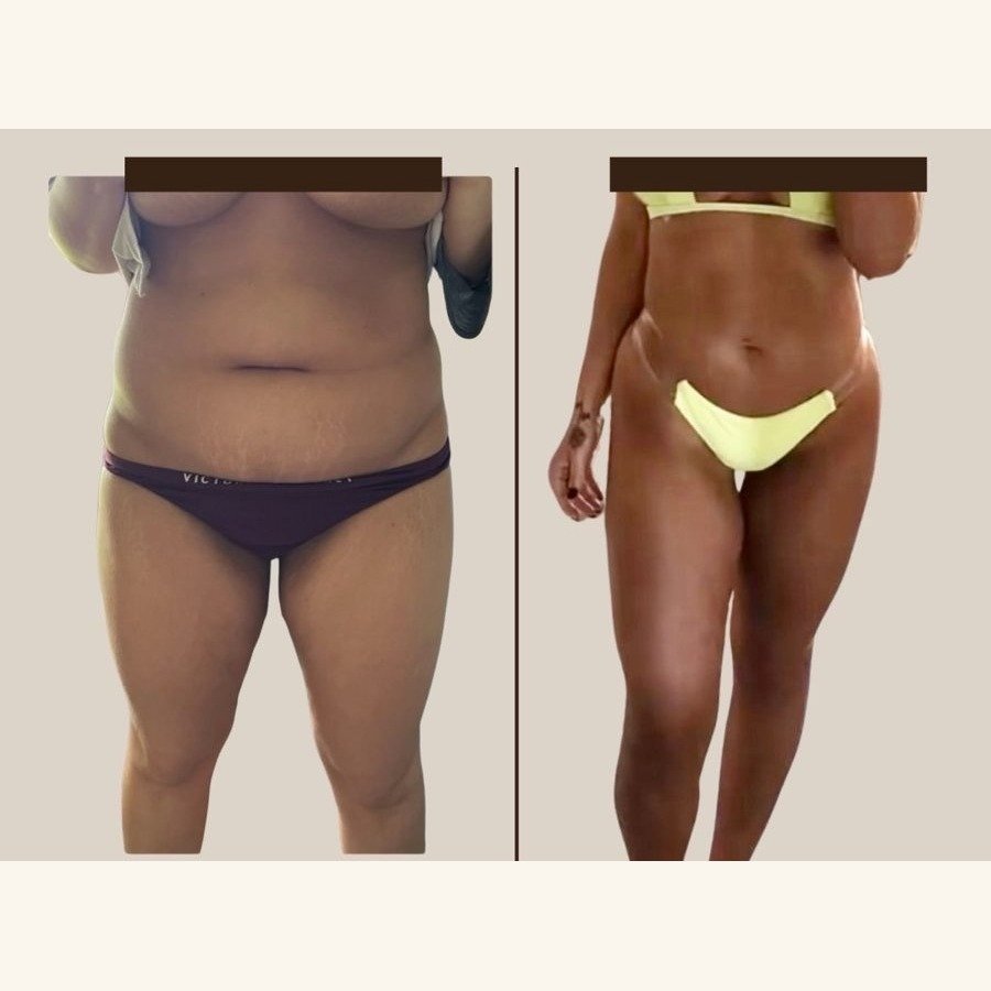 Before and after — weight loss & body treatment at Privé Aesthetics, Dallas
