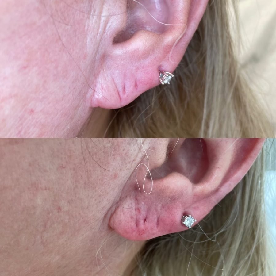 Before and after — injectables treatment at Privé Aesthetics, Dallas