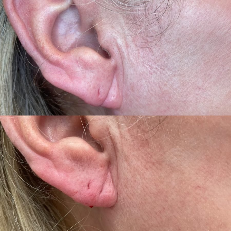 Before and after — injectables treatment at Privé Aesthetics, Dallas