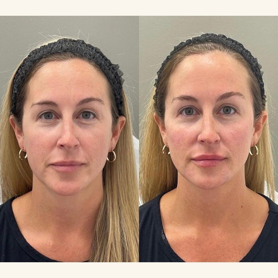 Before and after — injectables treatment at Privé Aesthetics, Dallas