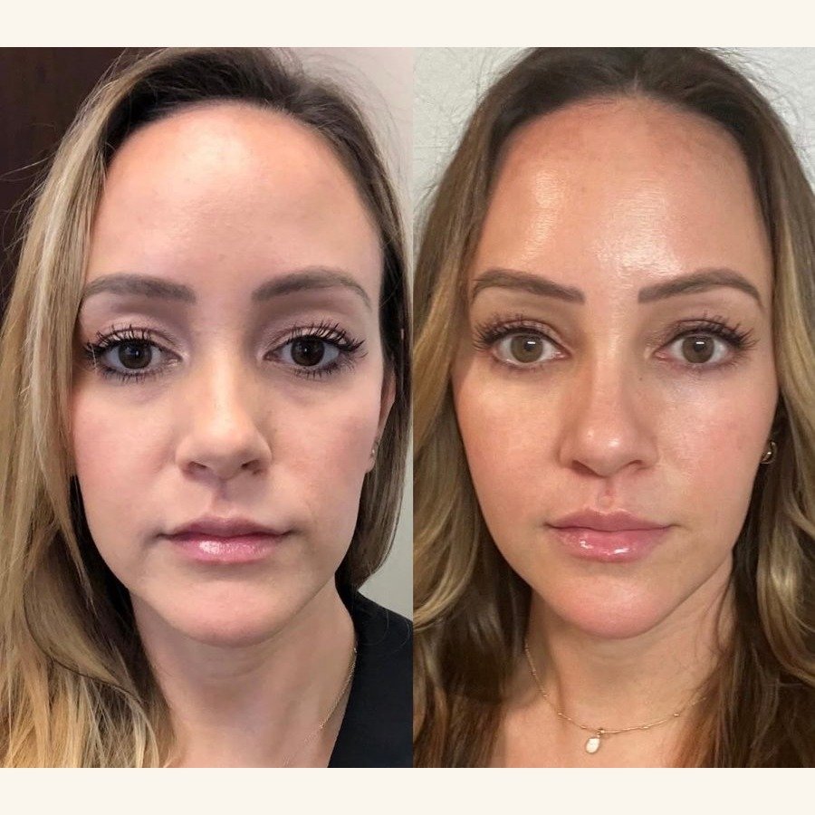 Before and after — injectables treatment at Privé Aesthetics, Dallas