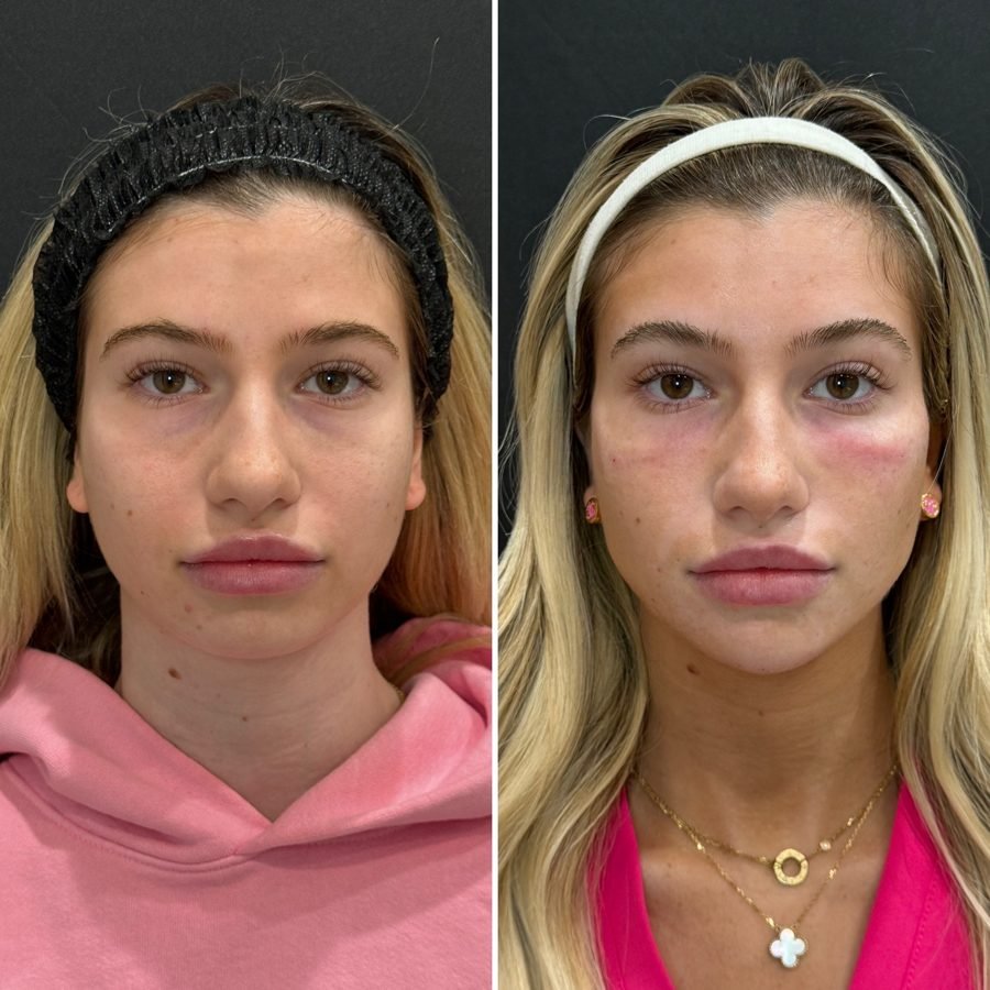 Before and after — injectables treatment at Privé Aesthetics, Dallas