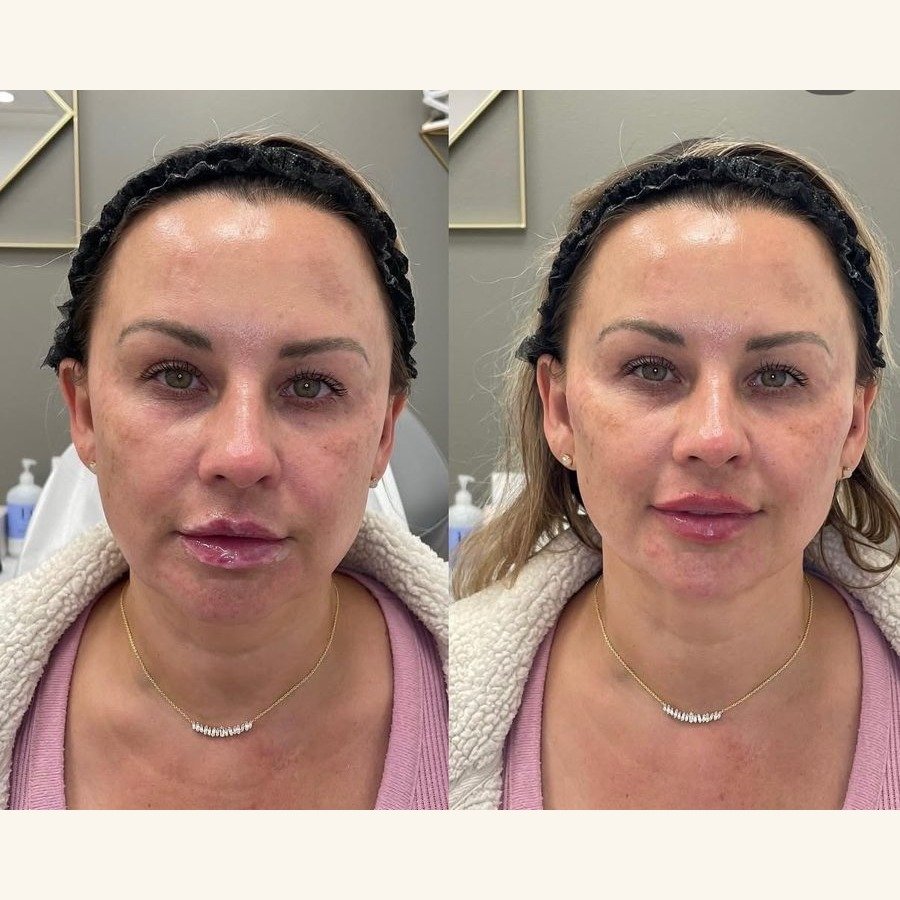Before and after — injectables treatment at Privé Aesthetics, Dallas