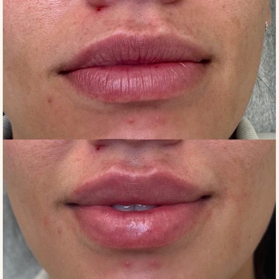 Before and after — injectables treatment at Privé Aesthetics, Dallas
