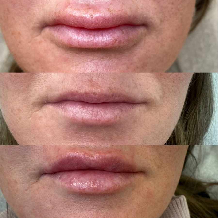 Before and after — injectables treatment at Privé Aesthetics, Dallas