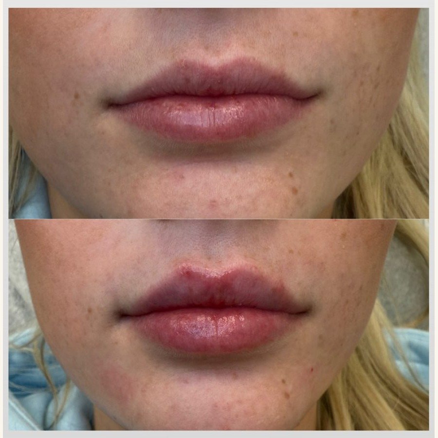 Before and after — injectables treatment at Privé Aesthetics, Dallas