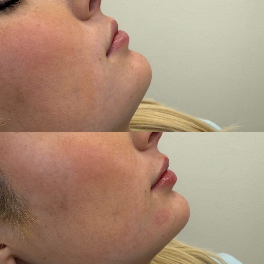 Before and after — injectables treatment at Privé Aesthetics, Dallas