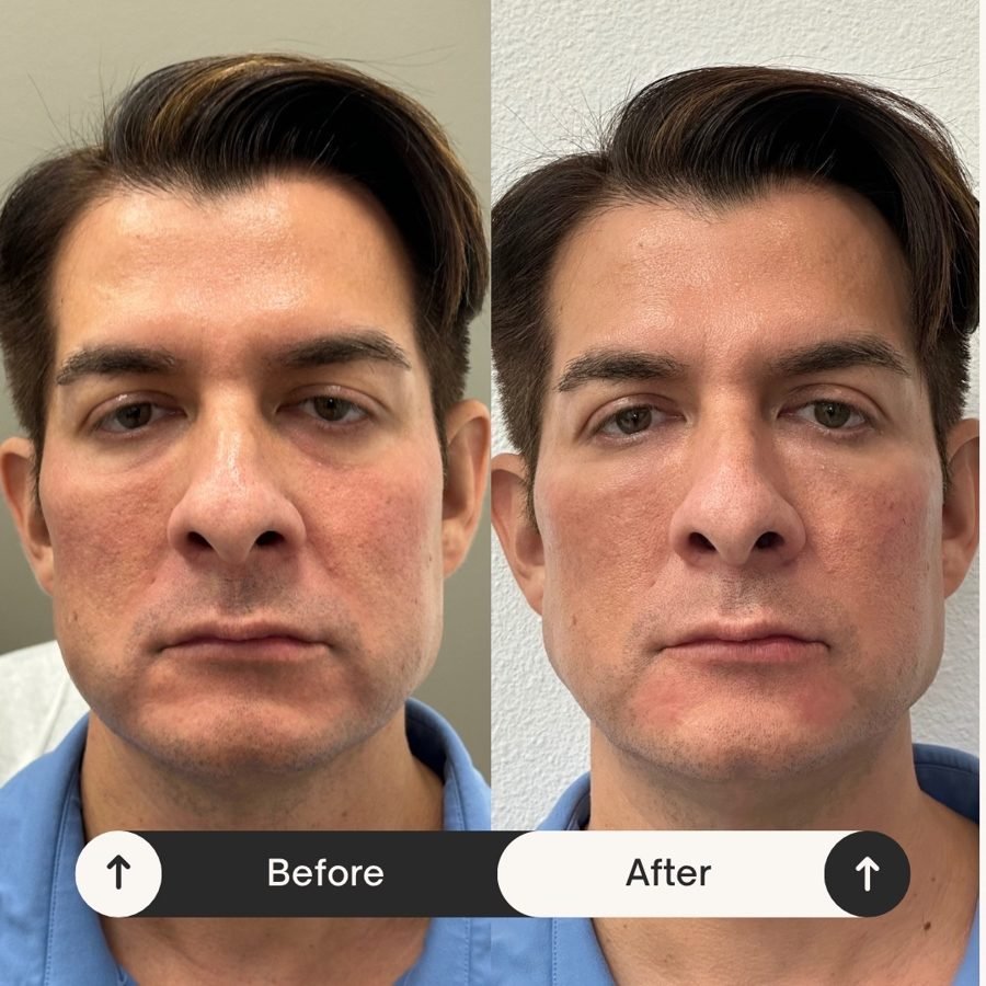 Before and after — injectables treatment at Privé Aesthetics, Dallas