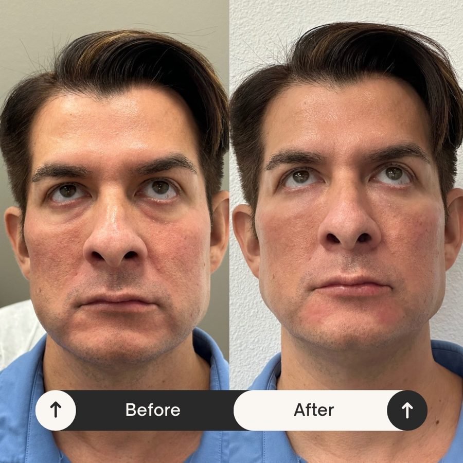 Before and after — injectables treatment at Privé Aesthetics, Dallas