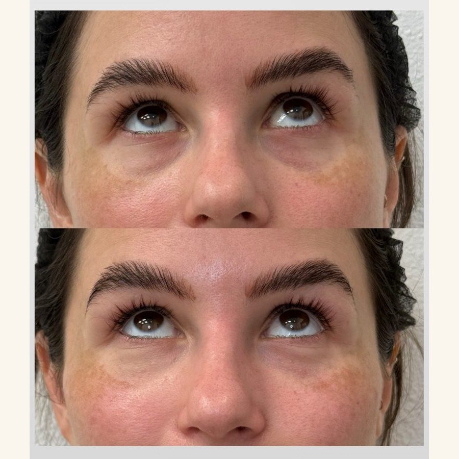 Before and after — injectables treatment at Privé Aesthetics, Dallas