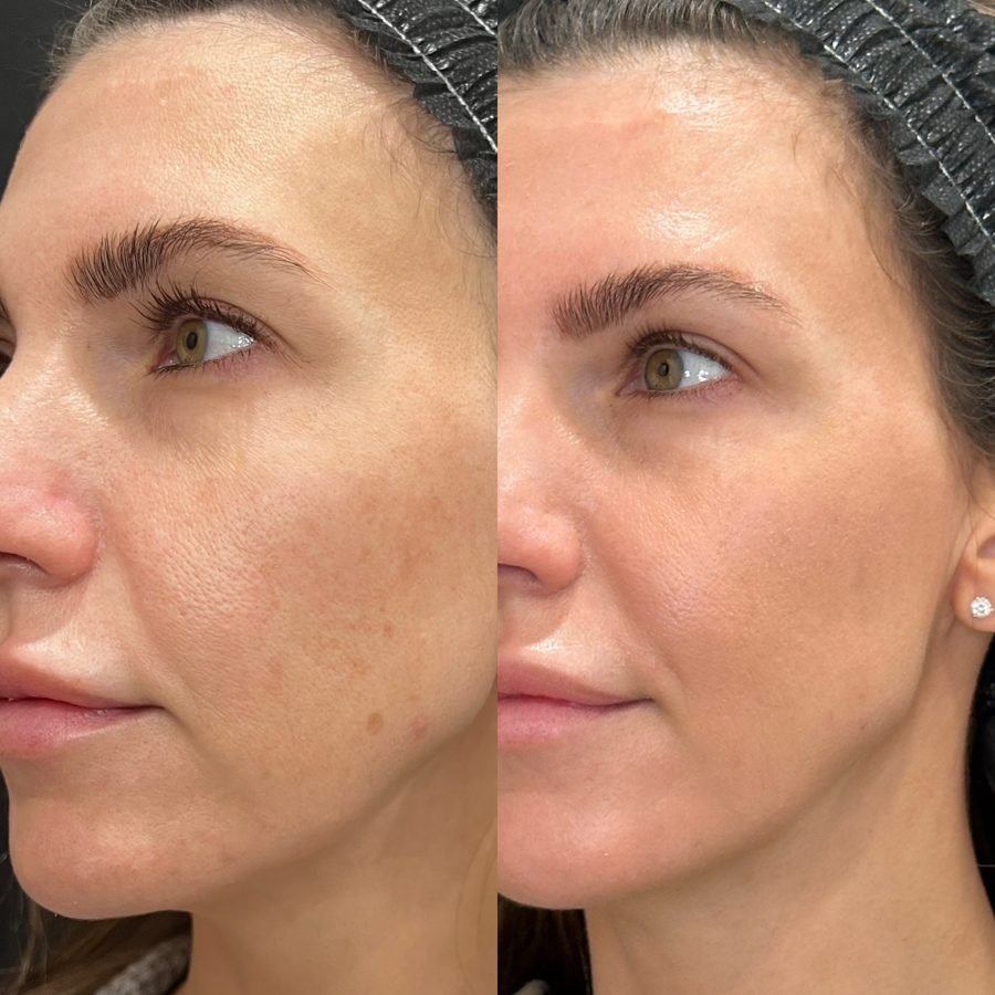 Before and after — skin health treatment at Privé Aesthetics, Dallas