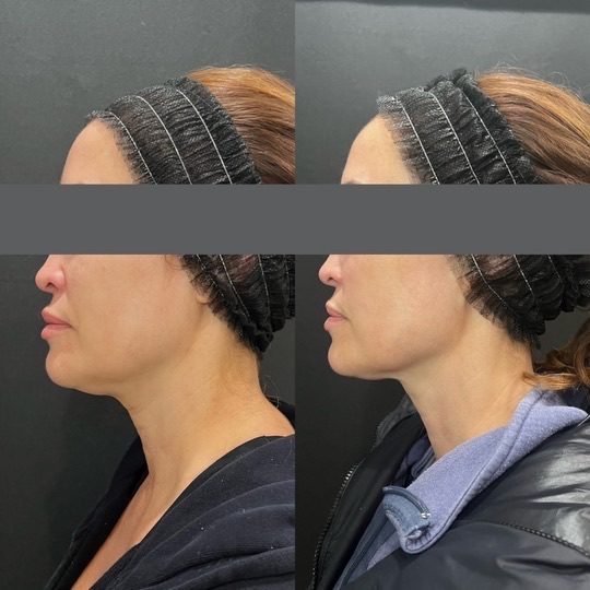 Before and after — skin health treatment at Privé Aesthetics, Dallas
