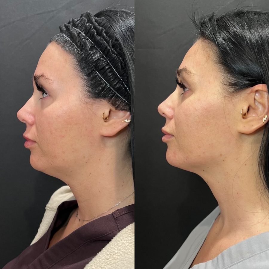 Before and after — skin health treatment at Privé Aesthetics, Dallas