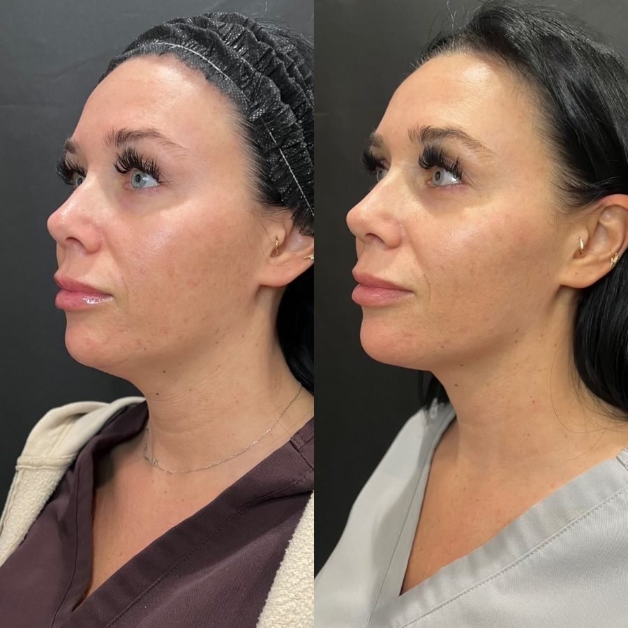 Before and after — skin health treatment at Privé Aesthetics, Dallas