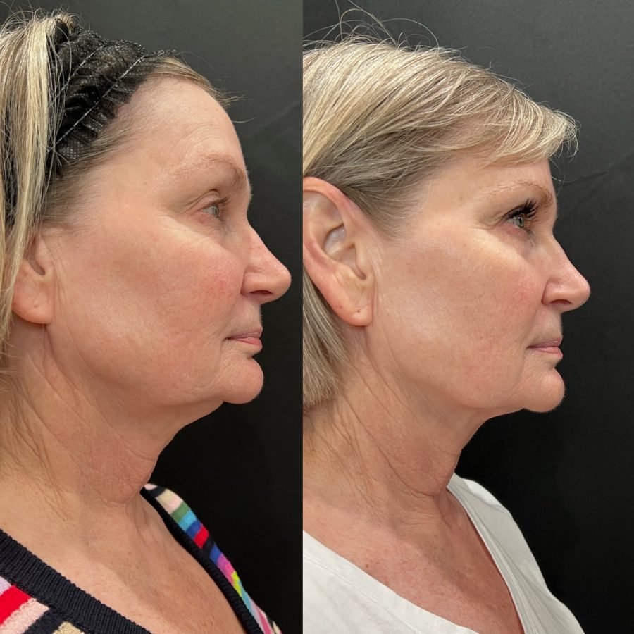 Before and after — skin health treatment at Privé Aesthetics, Dallas