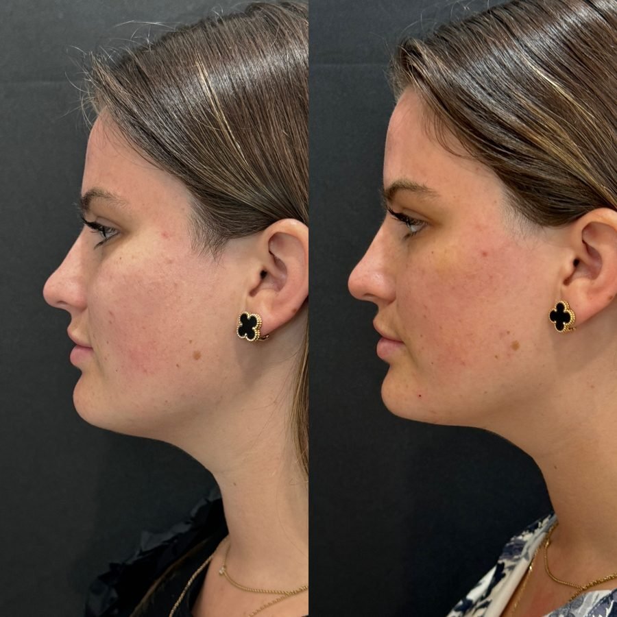 Before and after — skin health treatment at Privé Aesthetics, Dallas