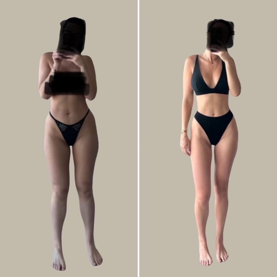 Before and after — wellness & peptides treatment at Privé Aesthetics, Dallas