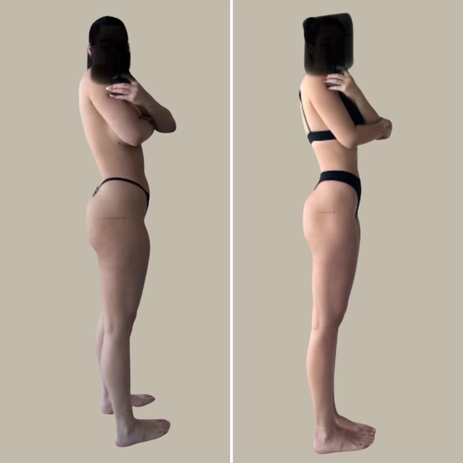 Before and after — wellness & peptides treatment at Privé Aesthetics, Dallas